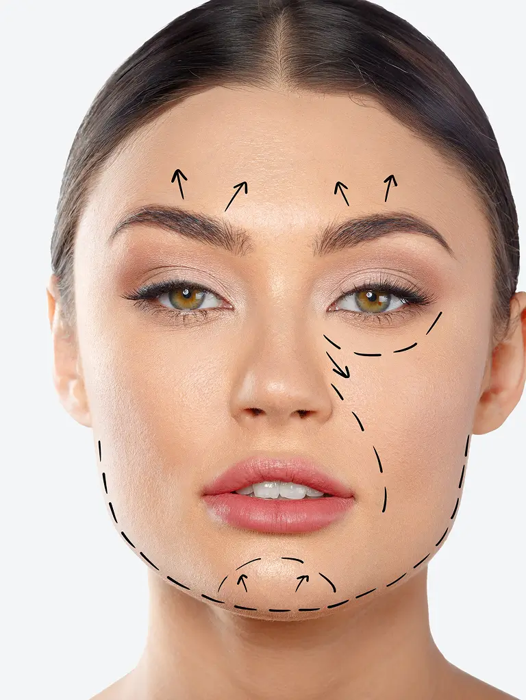 Dermal Fillers