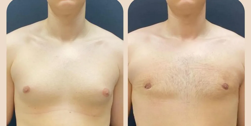 Gynecomastia