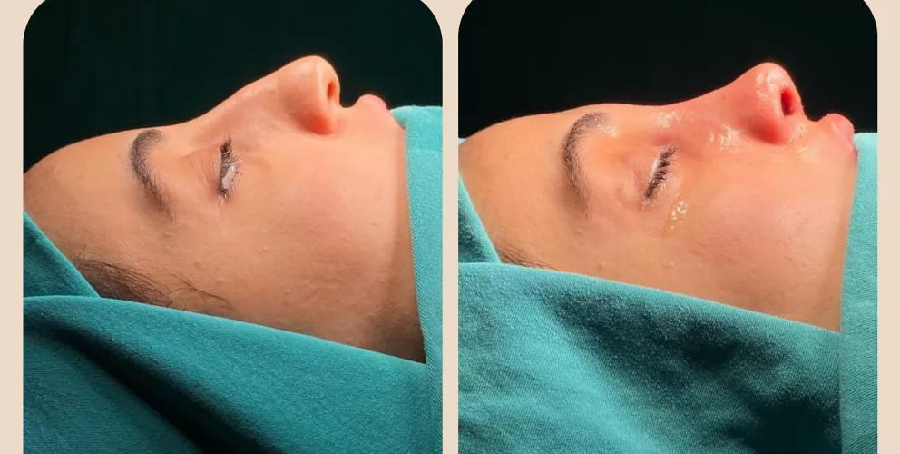 Rhinoplasty