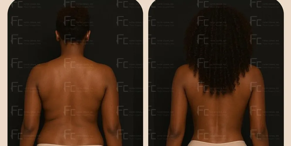 BBL (Brazilian Butt Lift)